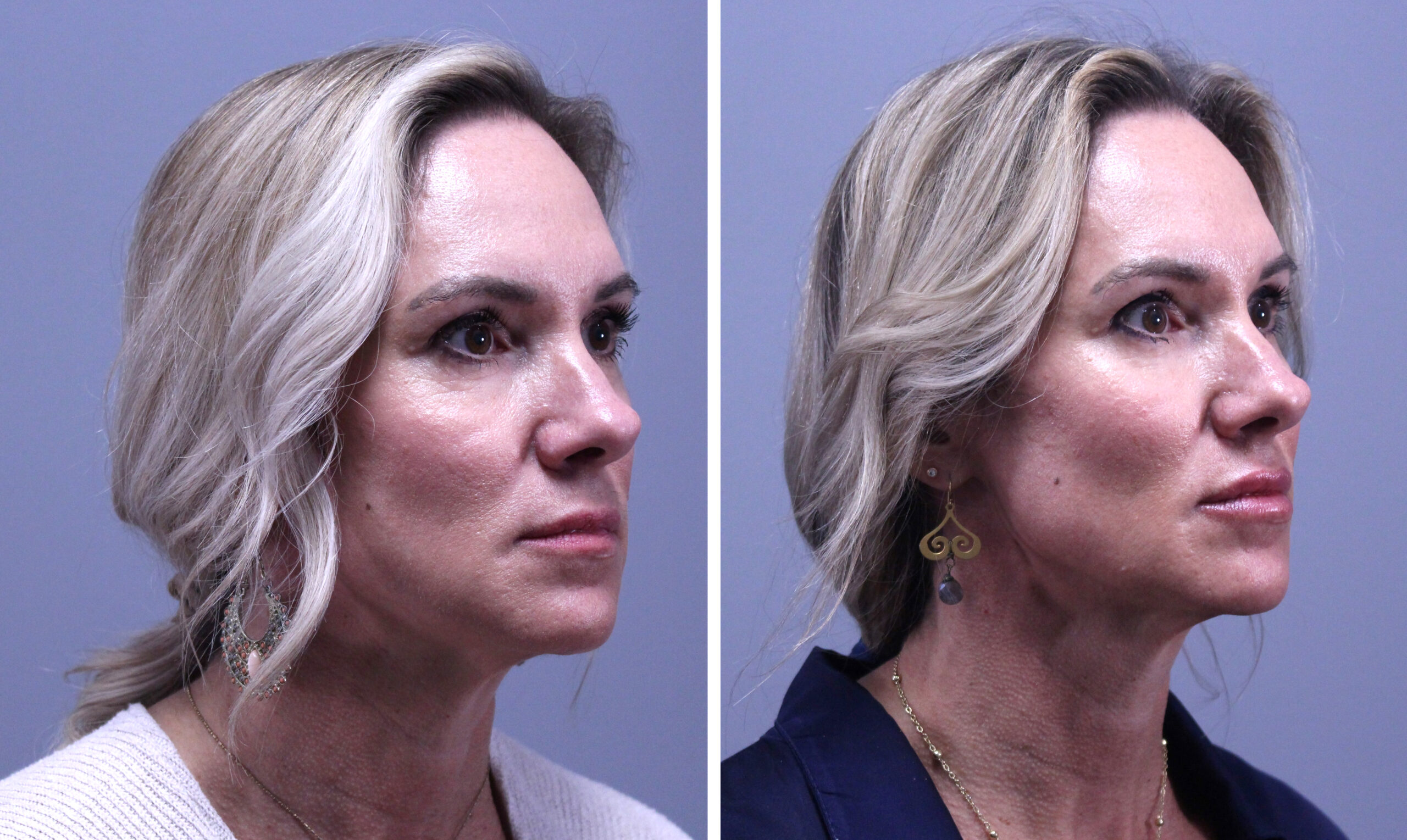 CombinedB&a Juvederm Voluma Before and After Pictures St. Petersburg, FL