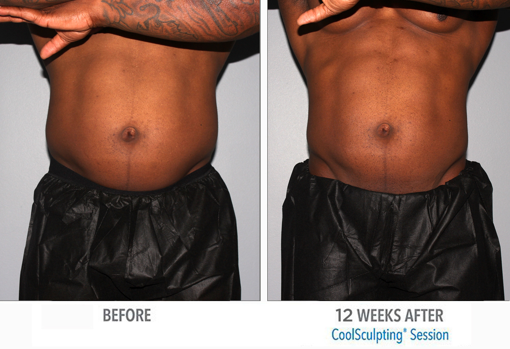 CoolSculpting  Before and After Pictures St. Petersburg, FL