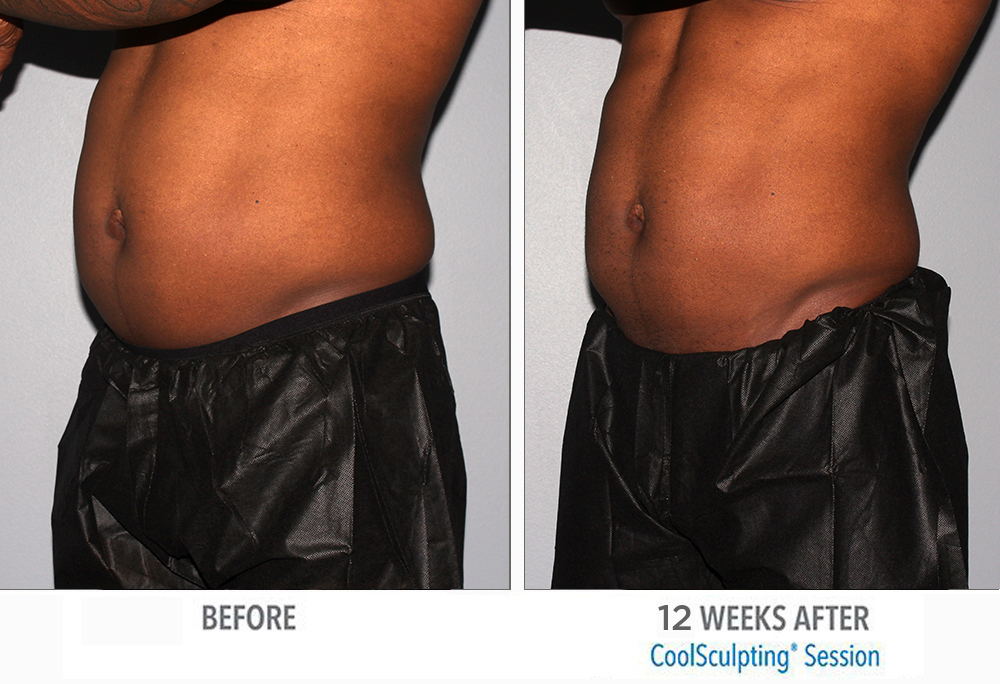 CoolSculpting  Before and After Pictures St. Petersburg, FL