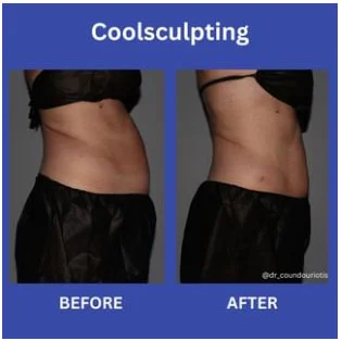 CoolSculpting Before and After Pictures St. Petersburg, FL