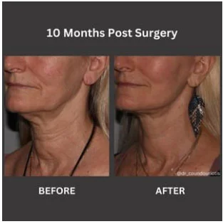 Facelift Before and After Pictures St. Petersburg, FL