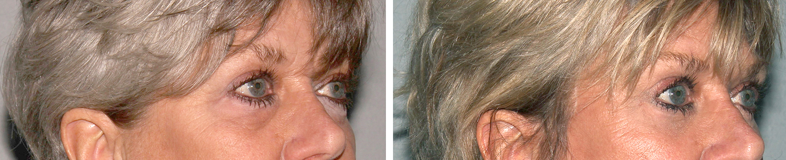 UpperLowerBlephboth Blepharoplasty Before and After Pictures St. Petersburg, FL