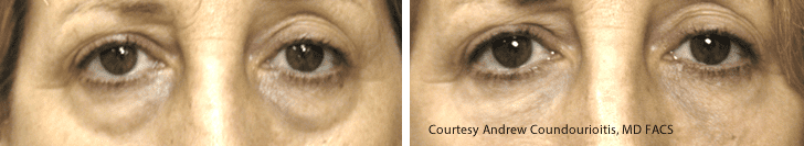 dermal-filler-1a Restylane Before and After Pictures St. Petersburg, FL